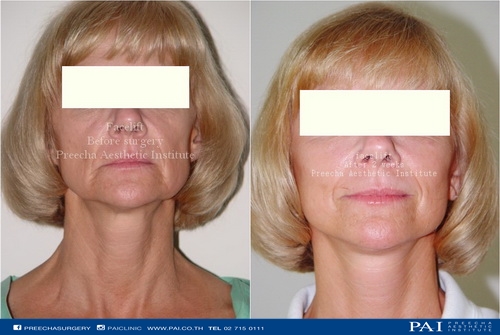 full facelift before and after 3 weeks l dr.preecha tiewtranon thailand