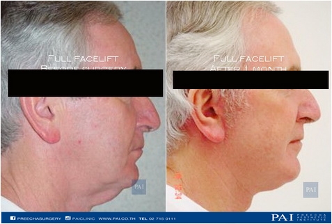 full facelift before and after one month l Preecha Aesthetic Institute 1
