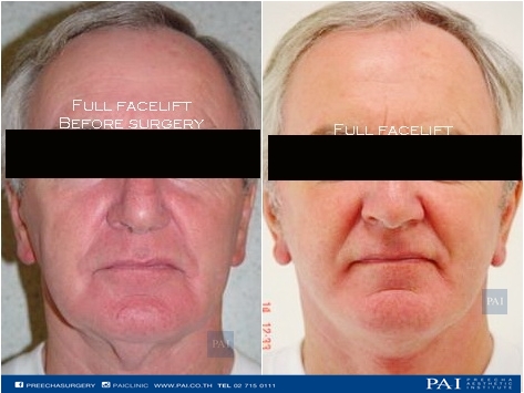 full facelift before and after one month l Preecha Aesthetic Institute