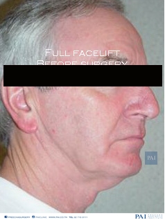 full facelift before surgery