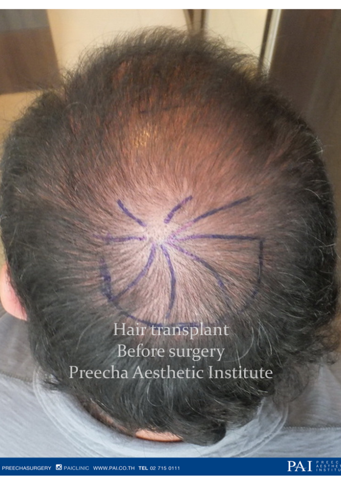hair transplant before surgery at preecha aesthetic institute