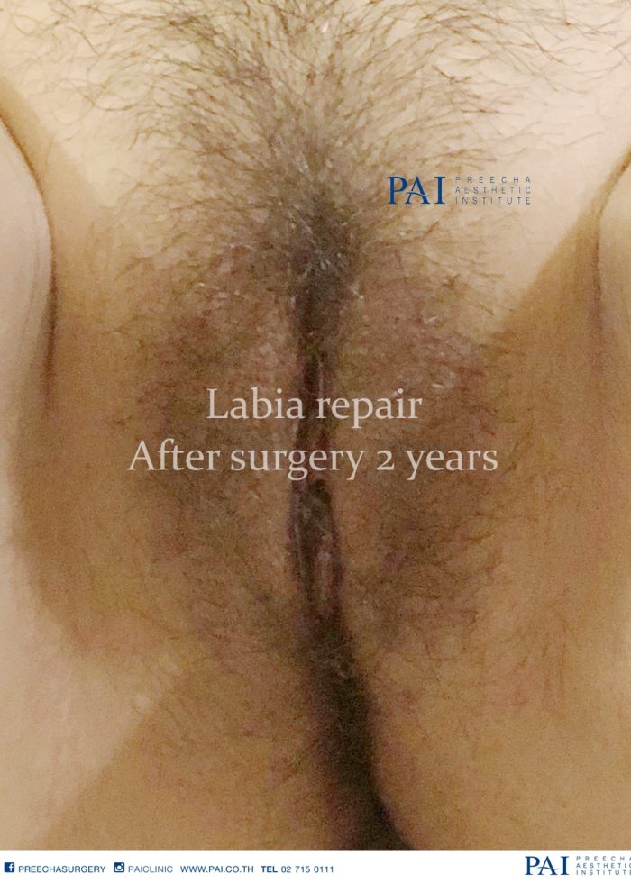 labia repair after 2 year preecha aesthetic institute