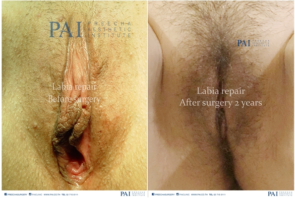 labia repair before and after 2 years surgery preecha aesthetic institute