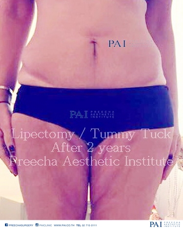lipectomy after surgery