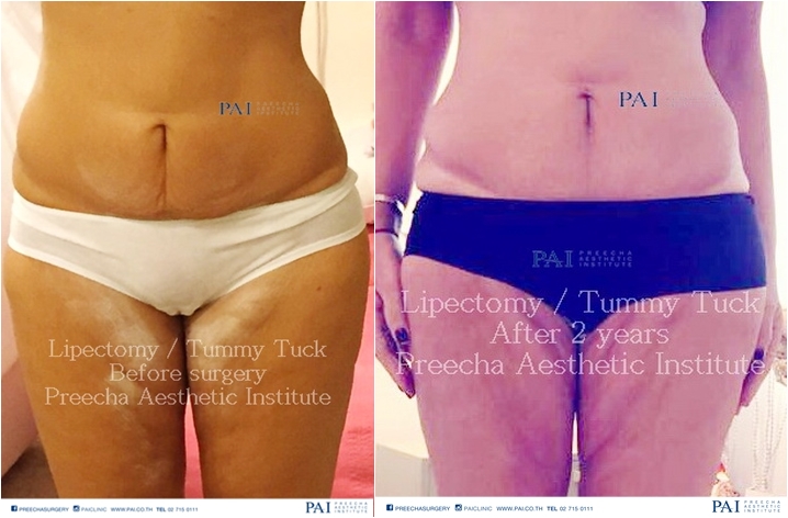 lipectomy before and after two years surgery