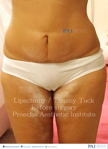 lipectomy before surgery