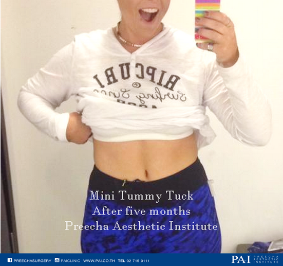 mini tummy tuck lady after five month preecha aesthetic institute