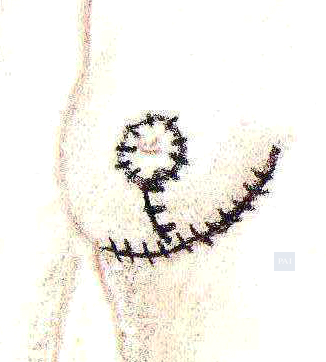 sample drawing breast reduction incision
