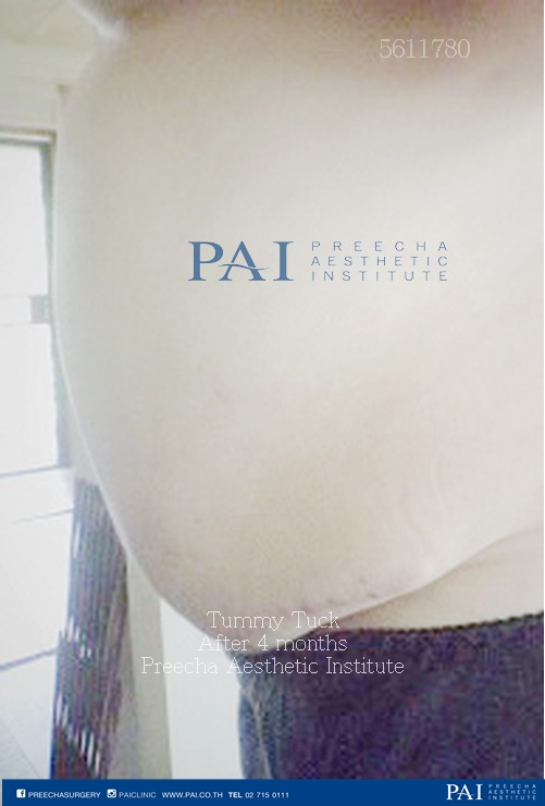 tummy tuck after 4 month preecha aesthetic institute leading cosmetic surgery thailand