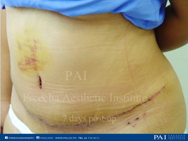tummy tuck after seven day preecha aesthetic institute