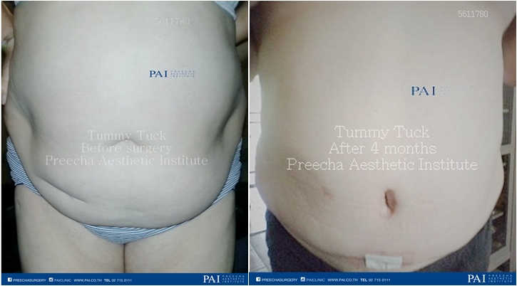 tummy tuck before and after surgery preecha aesthetic institute leading cosmetic surgery thailand