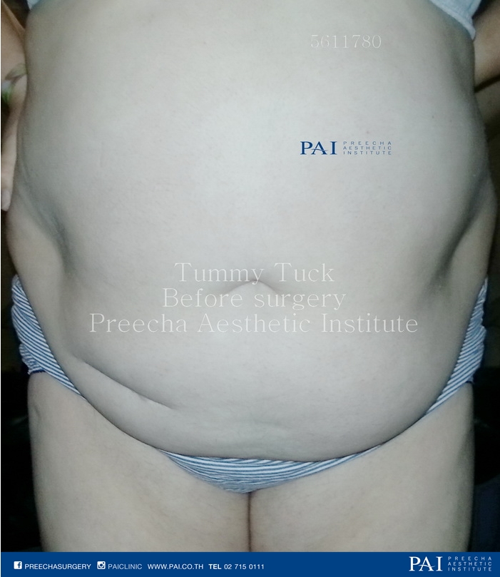 tummy tuck before surgery preecha aesthetic institute leading cosmetic surgery thailand