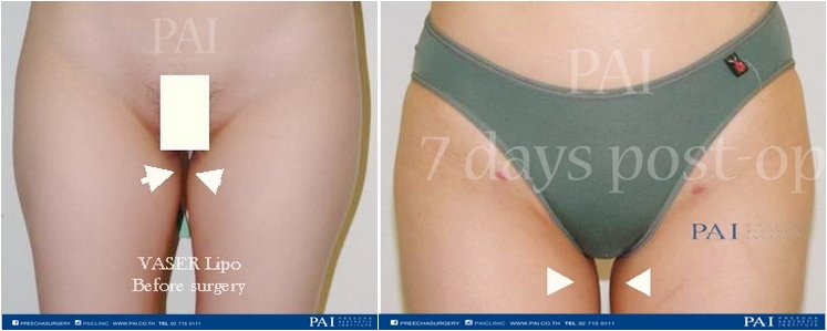 vaser liposelection before and after seven day surgery preecha aesthetic institute horz