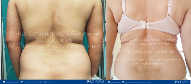vaser liposuction before and after four month surgery back area preecha aesthetic institute