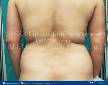 vaser liposuction before surgery back area