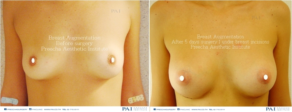 BREAST AUGMENTATION SAMPLE RESULT UNDER breast INCISION BEFORE AFTER 5 DAYS l Preecha Aesthetic Institute