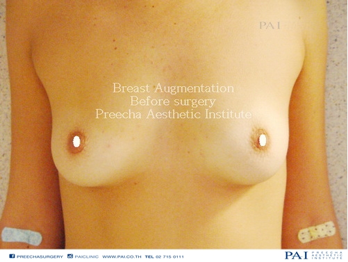 BREAST AUGMENTATION SAMPLE RESULT UNDER ARMPIT INCISION BEFORE