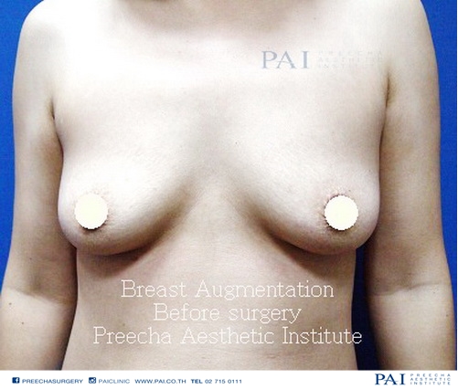 BREAST AUGMENTATION SAMPLE RESULT UNDER ARMPIT INCISION before surgery
