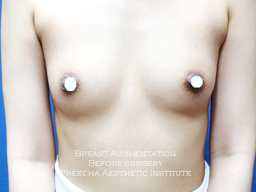 Breast Aug before surgery