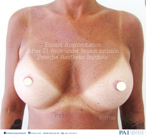 Breast Augmentation after 21 days under breast incision l Preecha Aesthetic Institute