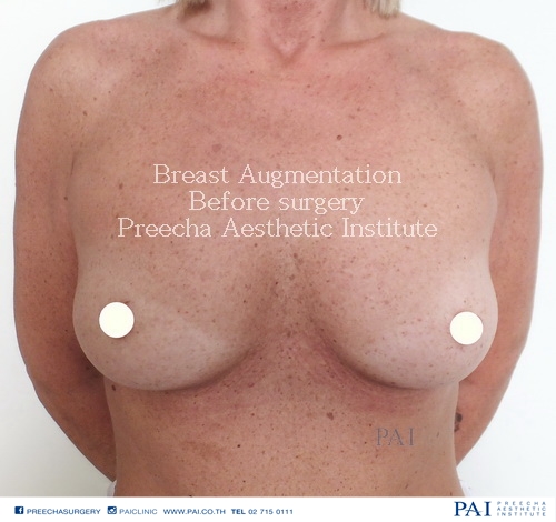 Breast Augmentation l Preecha Aesthetic Institute