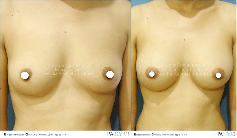augmentation mammoplasty before surgery 210 cc after surgery