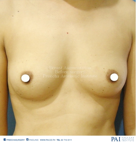 augmentation mammoplasty before surgery