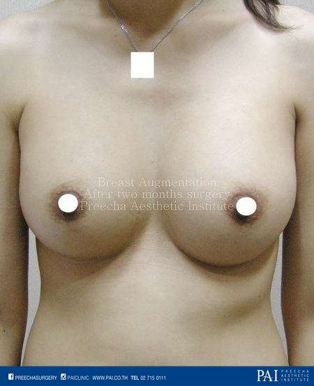 boob augmentation after surgery