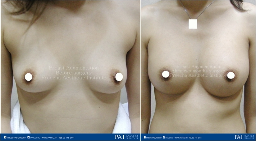 boob augmentation before surgery after