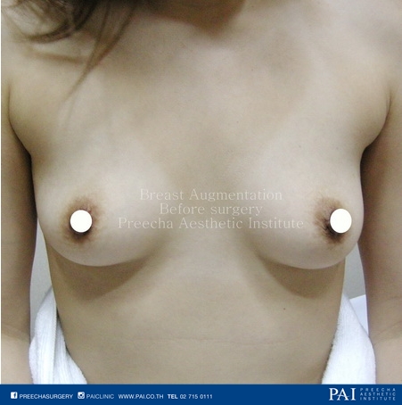 boob augmentation before surgery
