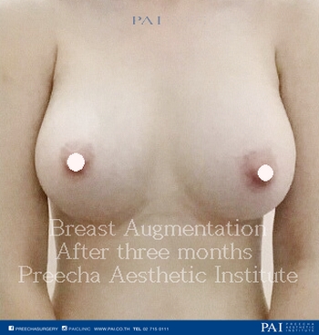 boob implant after three months preecha aesthetic institute bangkok thailand