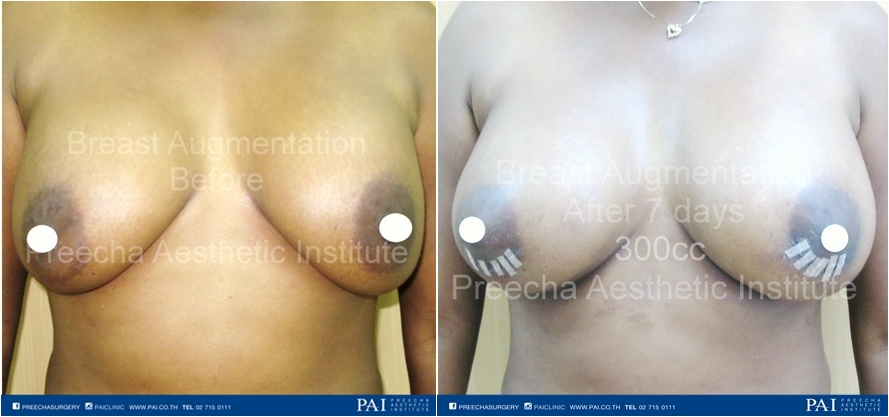 breast aug before after surgery Periareolar
