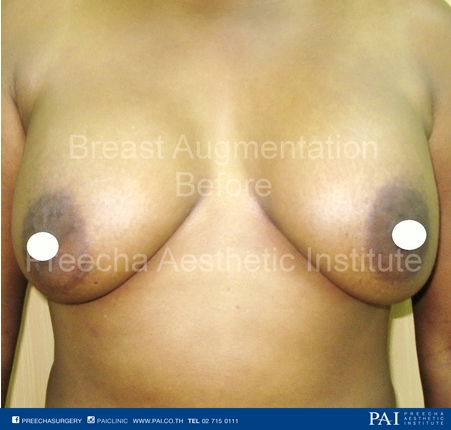 breast aug before surgery