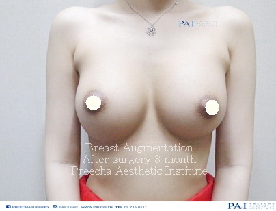 breast augmentation after 3 months under armpits incision l Preecha Aesthetic Institute