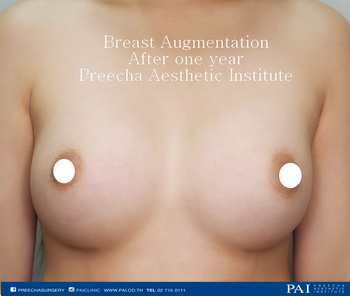 breast augmentation after one year surgery preecha aesthetic institute