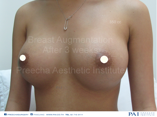 breast augmentation after three weeks under armpitts l Preecha Aesthetic Institute