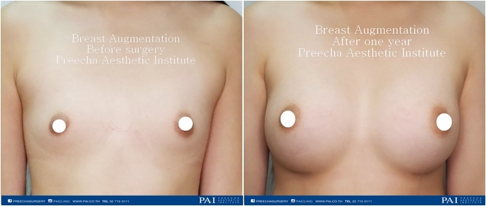 breast augmentation before after one year surgery preecha aesthetic institute