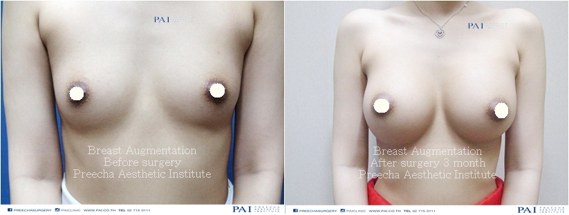 breast augmentation before and after 3 months under armpits incision l Preecha Aesthetic Institute