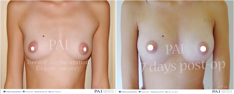 breast augmentation before and after surgery 275 cc l Preecha Aesthetic Institute