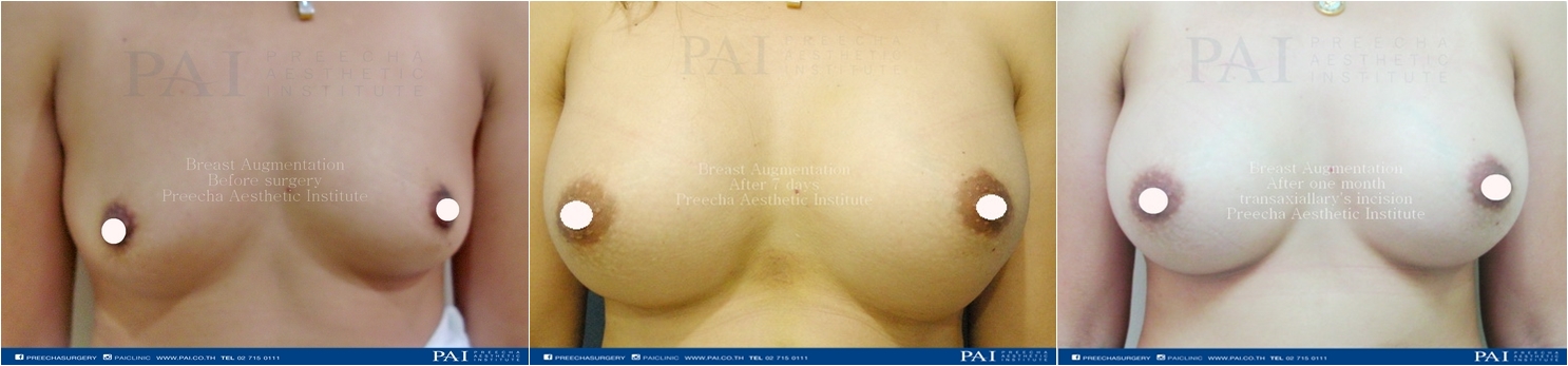 breast augmentation before and after surgery transaxiallary l preecha aesthetic institute