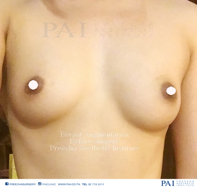 breast augmentation before surgery by preecha aesthetic institute