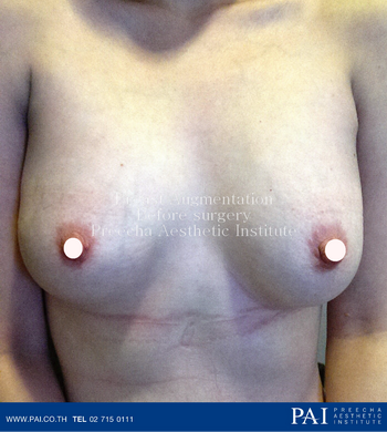 breast augmentation before surgery by preecha aesthetic institute bangkok