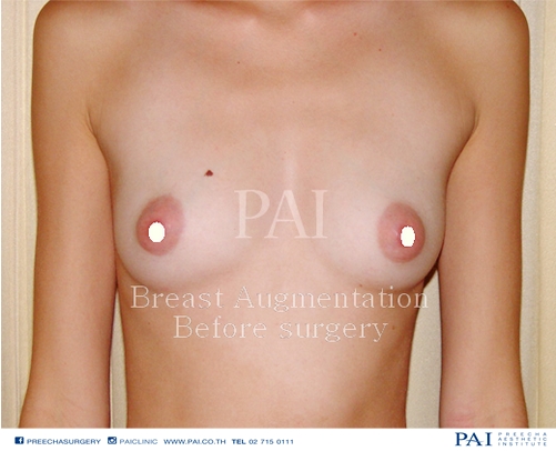 breast augmentation before surgery l Preecha Aesthetic Institute 1