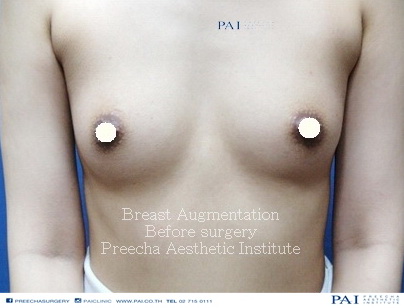 breast augmentation before surgery l Preecha Aesthetic Institute