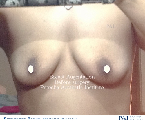 breast augmentation before surgery l Preecha Aesthetic Institute