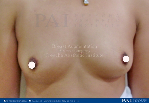 breast augmentation before surgery l preecha aesthetic institute
