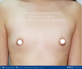 breast augmentation before surgery preecha aesthetic institute