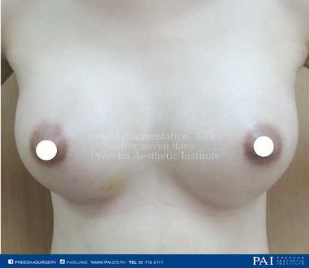 breast implant after 350 cc