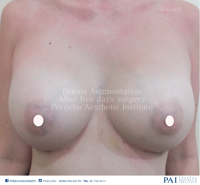 breast implant after five days preecha aesthetic institute bangkok thailiand best breast augmentation