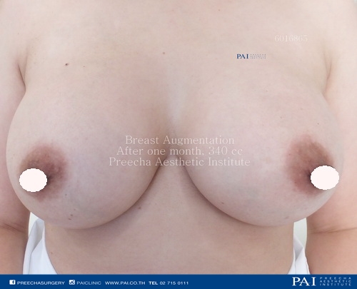 breast implant after surgery, preecha aesthetic institute bangkok thailand